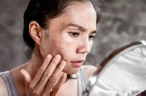 Cara Ampuh Menghilangkan Flek Hitam di Wajah