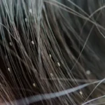 Obat Alami Terbaik untuk Mengatasi Kutu Rambut Anak secara Efektif
