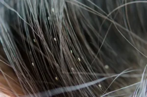 Obat Alami Terbaik untuk Mengatasi Kutu Rambut Anak secara Efektif