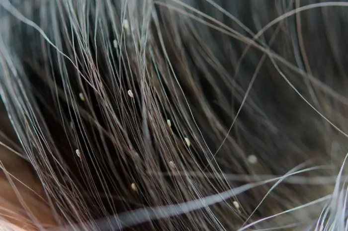 Obat Alami Terbaik untuk Mengatasi Kutu Rambut Anak secara Efektif